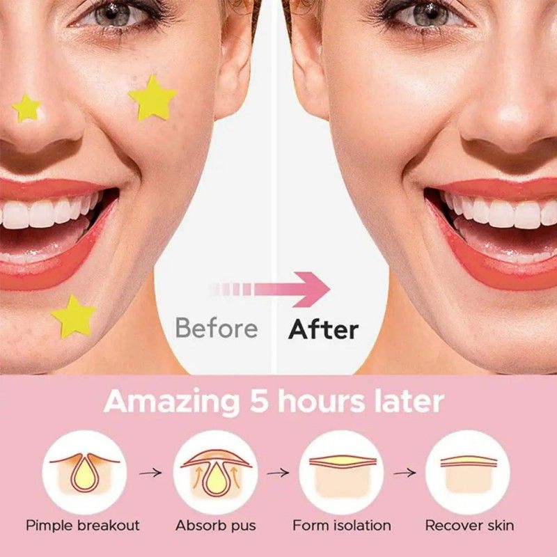 Acne Patch Pimple Acne Relief Patches Five-Color 600pcs