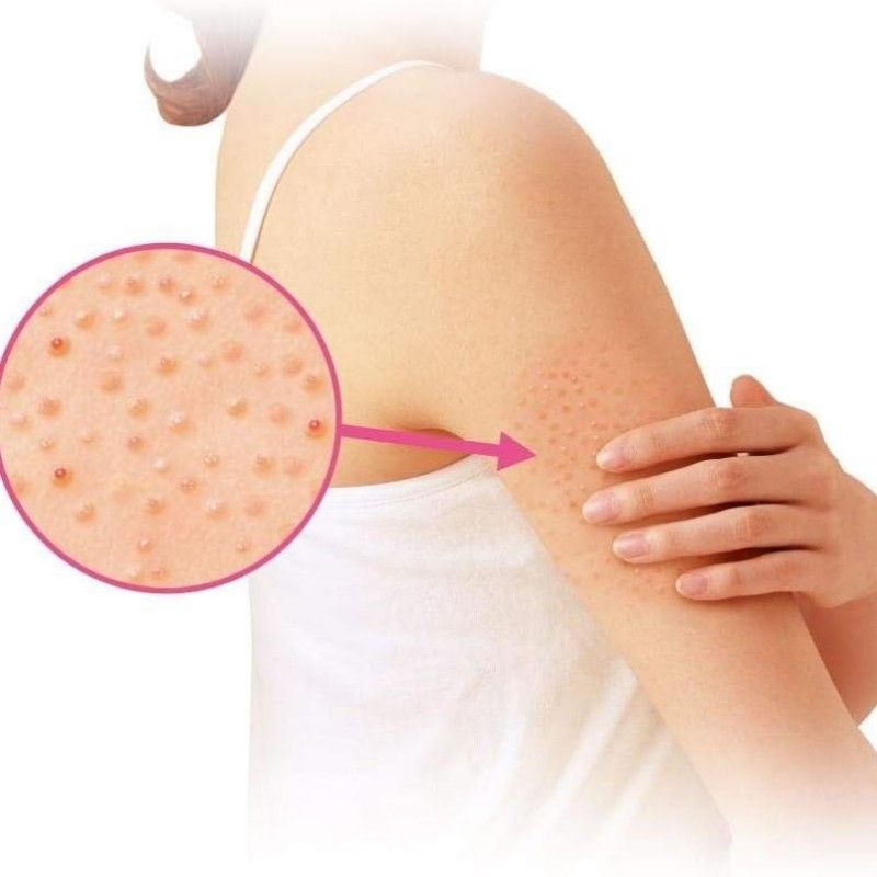 Kobayashi NinoCure Nino Cure Cream 30g