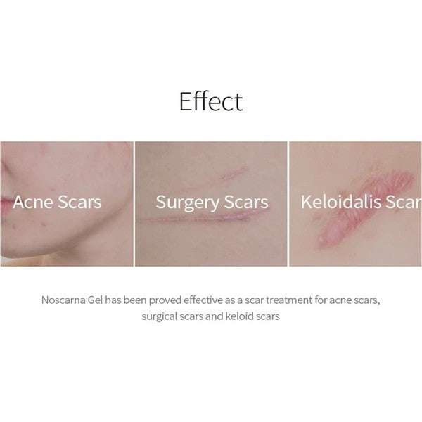 Donga Pharm Noscarna Acne Scars Removal Gel 13g