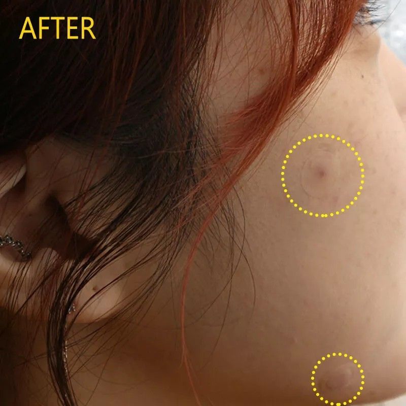 Olive Young微针痘痘贴水杨酸积雪草隐形吸脓 12枚