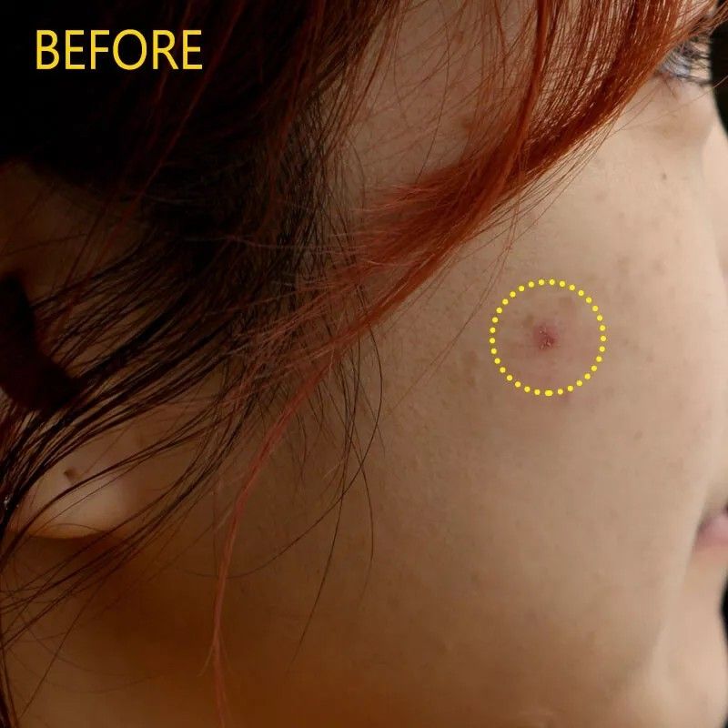 Olive Young微针痘痘贴水杨酸积雪草隐形吸脓 12枚