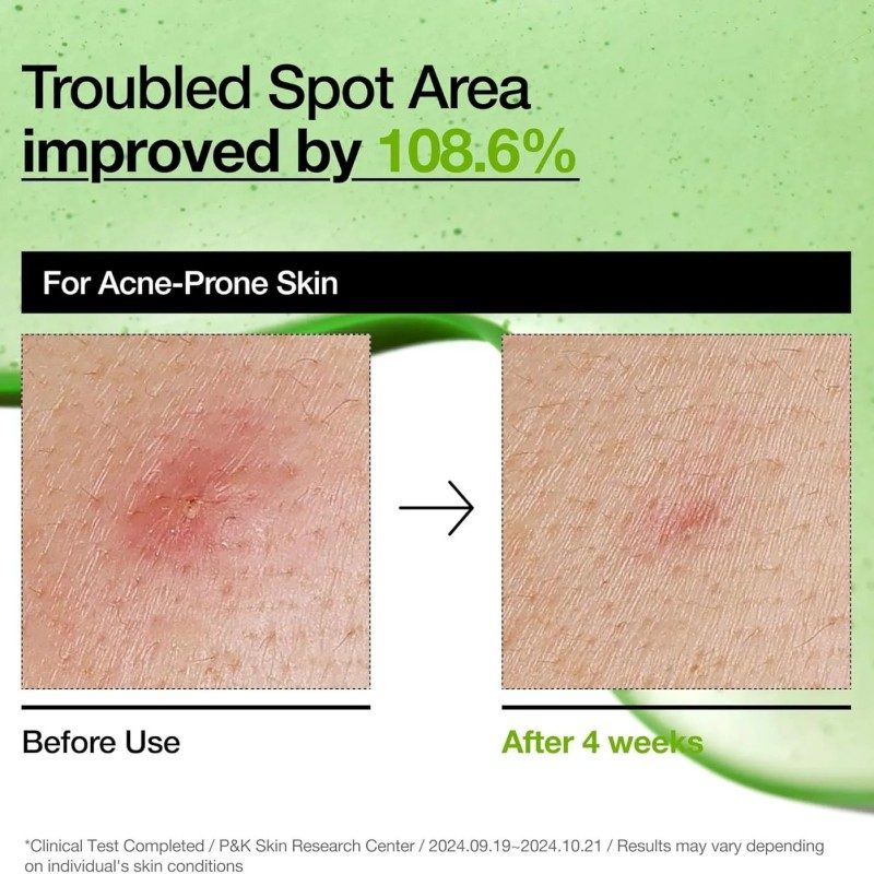 Anua Azelaic Acid 10 Hyaluron Redness Soothing Serum 30ml