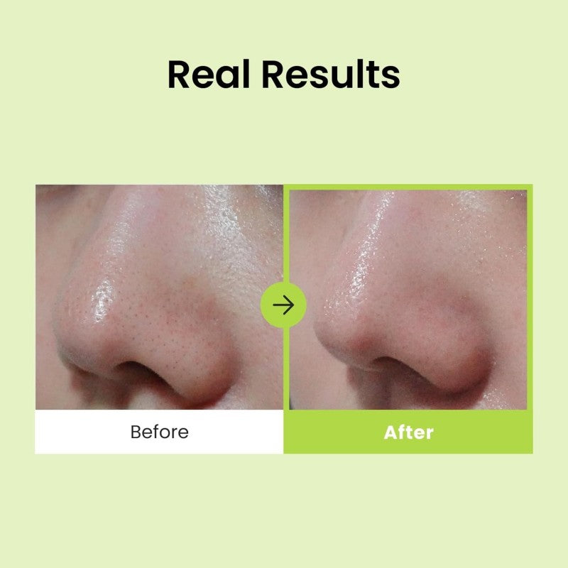 CNP Laboratory Anti-Pore Blackhead Perfect Clear Kit 10 Sets