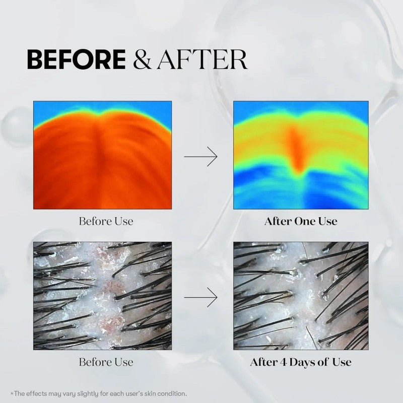 VT头皮精华微针生发安瓶100dL 15ml