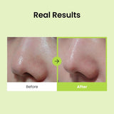 CNP Laboratory Anti-Pore Blackhead Perfect Clear Kit 10 Sets